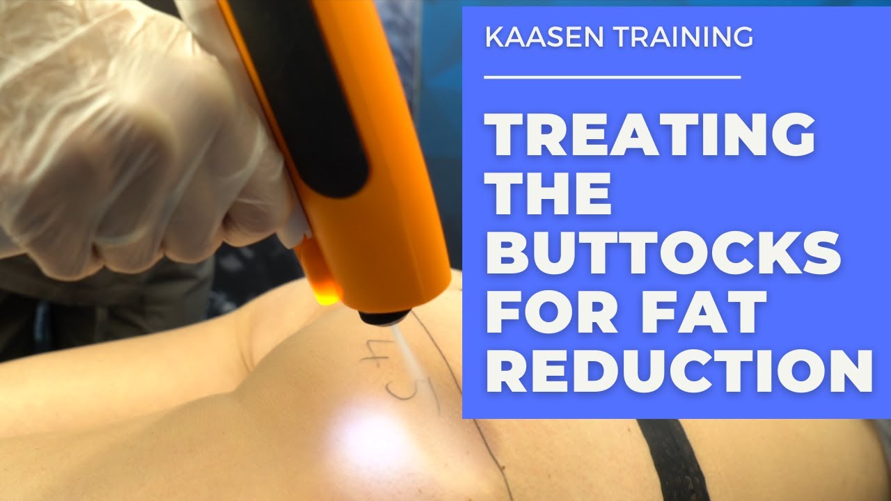 Kaasen Training - Treating the Buttocks for Fat Reduction